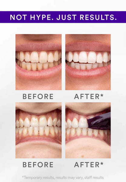 💎Whitening Strips That Show Real Results After Just One Use — 🔥Limited Time 80% OFF🔥