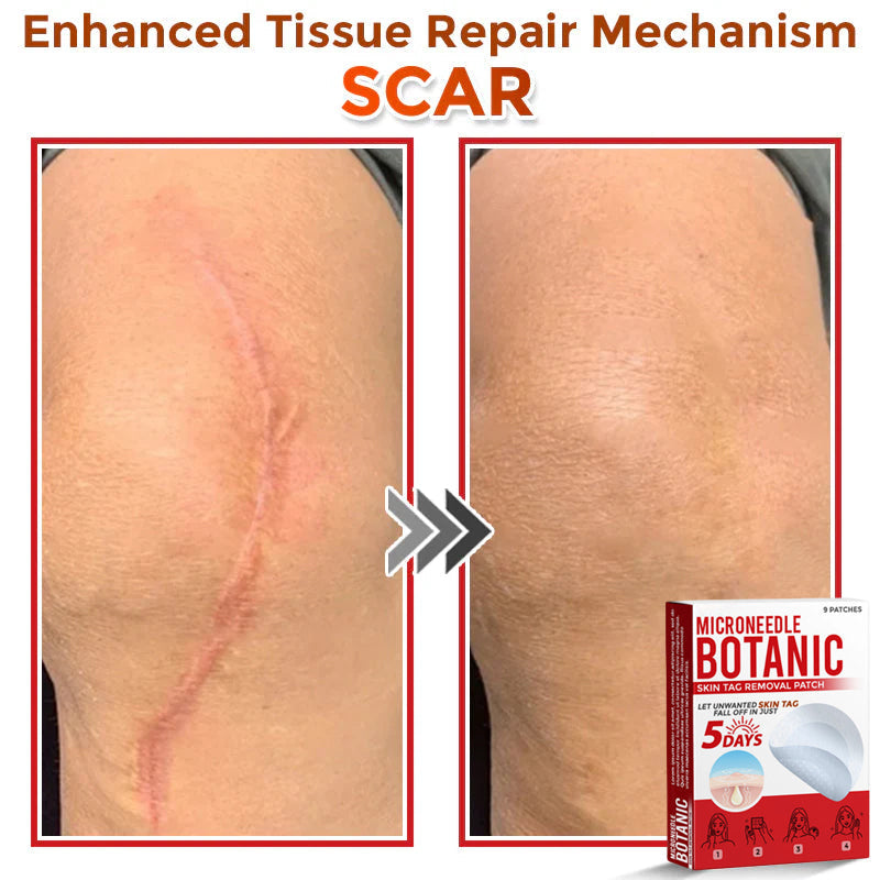 🌈MicroNeedle Botanic Skin Tag Removal Patch 🇺🇸 Made in the USA