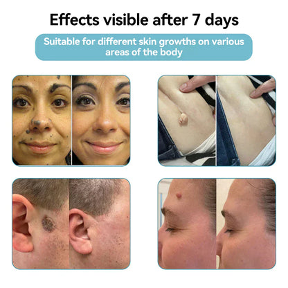 💎QIAWI™ All-in-One CO₂ Laser Eraser Pen | Removes Moles, Warts, Skin Flaws & Pigmentation
