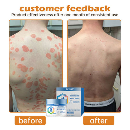 🔥Top Dermatologist: Psoriasis Cure Vitamin D Cream