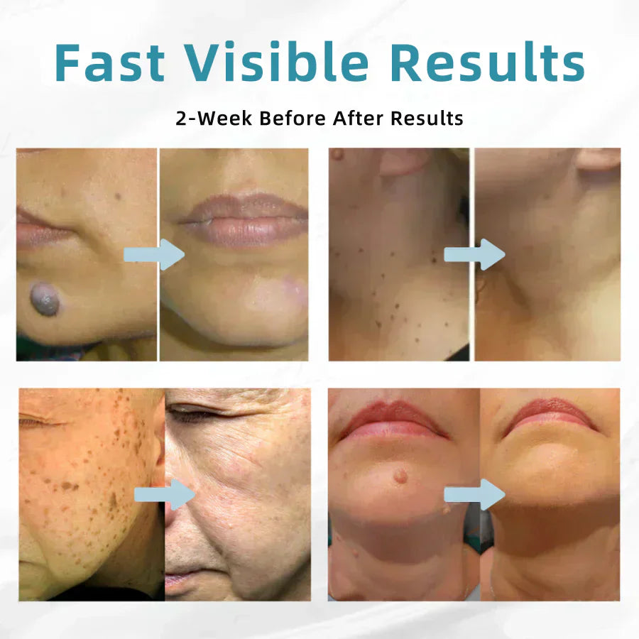 💎QIAWI™ All-in-One CO₂ Laser Eraser Pen | Removes Moles, Warts, Skin Flaws & Pigmentation
