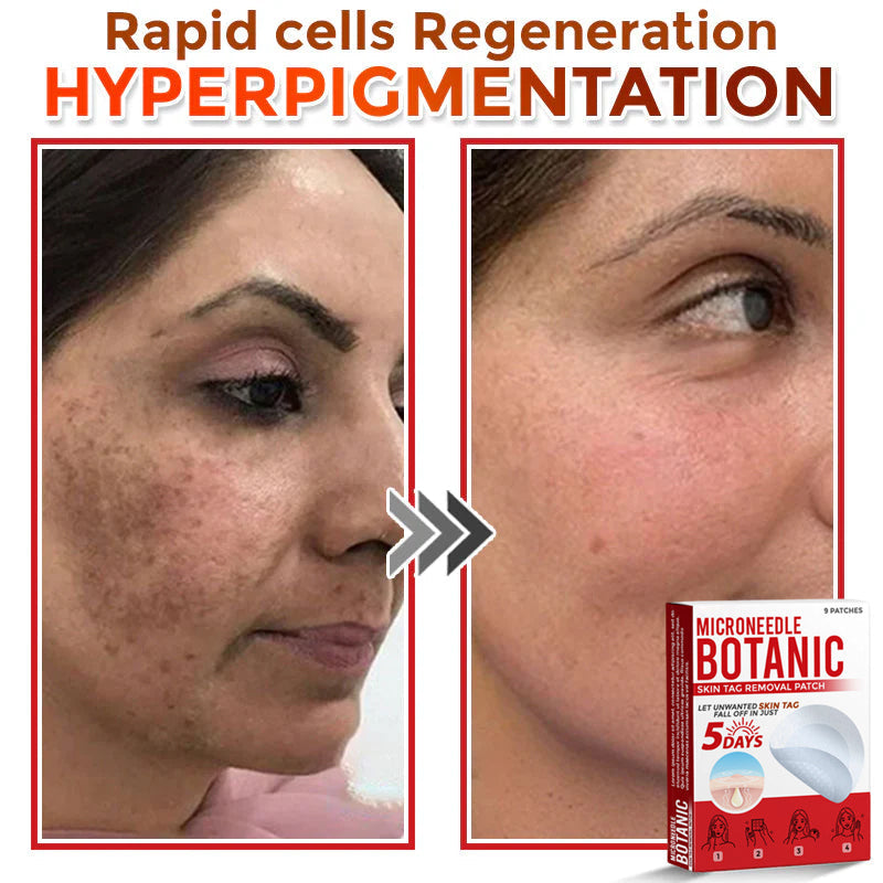 🌈MicroNeedle Botanic Skin Tag Removal Patch 🇺🇸 Made in the USA