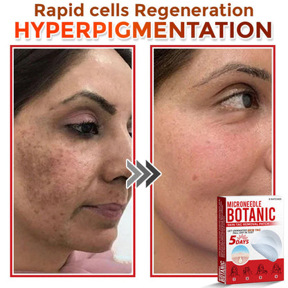 🌈MicroNeedle Botanic Skin Tag Removal Patch 🇺🇸 Made in the USA