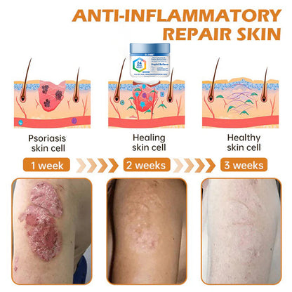 🔥Top Dermatologist: Psoriasis Cure Vitamin D Cream