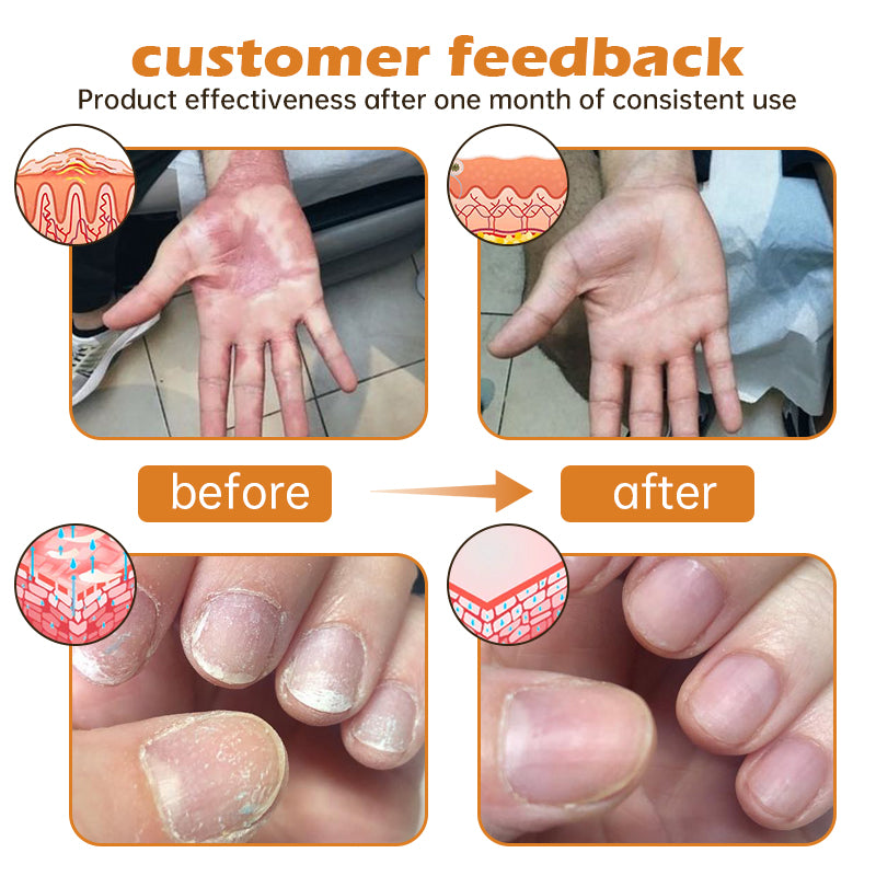 🔥Top Dermatologist: Psoriasis Cure Vitamin D Cream