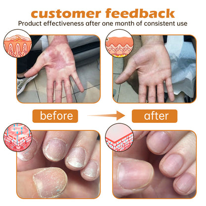 🔥Top Dermatologist: Psoriasis Cure Vitamin D Cream