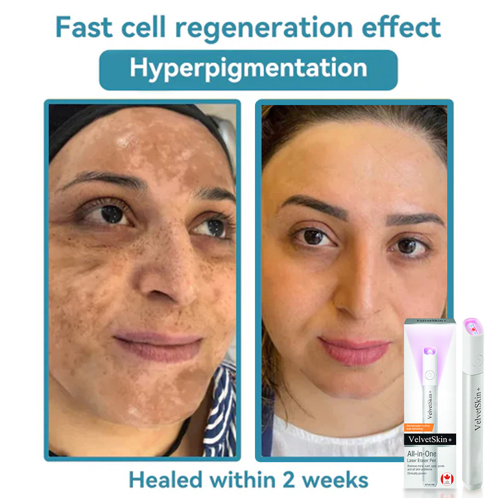 💎QIAWI™ All-in-One CO₂ Laser Eraser Pen | Removes Moles, Warts, Skin Flaws & Pigmentation